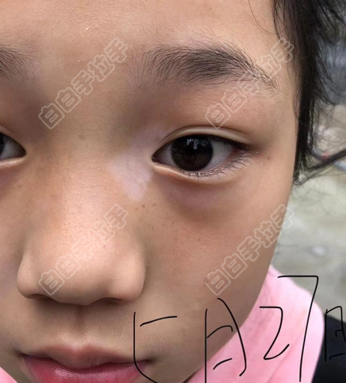 我家12岁女孩眼角上长了白白