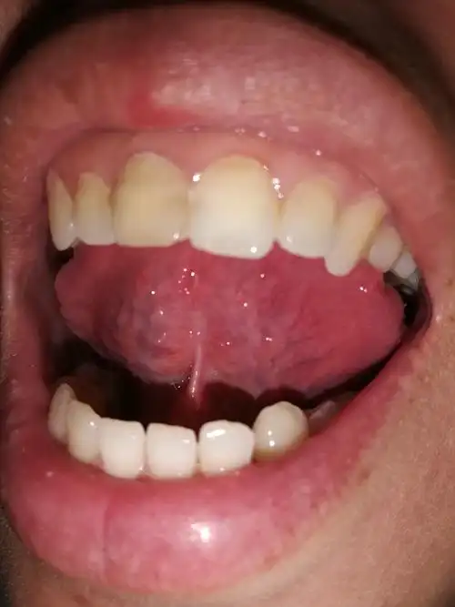 舌下络脉有瘀20%