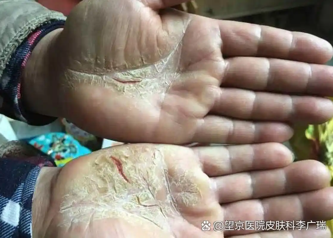 遇到皲裂性湿疹,不要等到变成慢性湿疹再治疗!