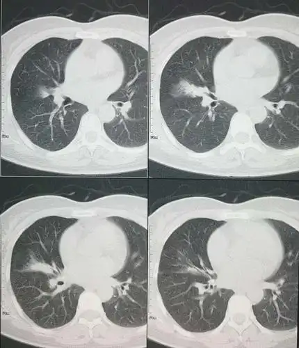 中叶综合征(肺叶楔形切除后,一个月仍见较多胸腔积液病例汇总)