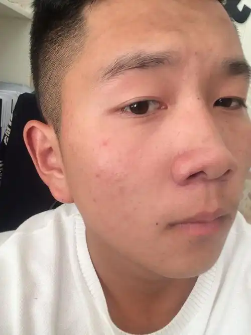 男,年龄21岁,抽烟,右侧脸颊突然长了好多痘痘,特别是右眼眼角居多,请