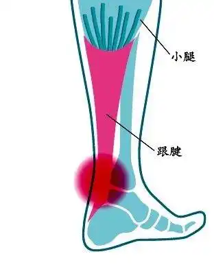 跟腱炎/跟腱腱病