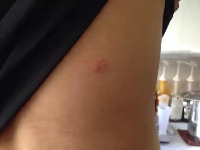 那个部位很痛平时坐下碰到都痛请问是什么来的是被虫子咬了