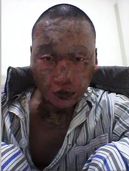 病情描述:浅二度烧伤,面部没有留下疤痕,只是脱了一层皮,前两天皮肤呈