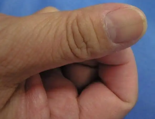 经典病例:甲乳头瘤