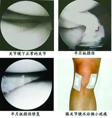 主要症状:半月板损伤多出现膝关节一侧 疼痛 ,位置固定;或股四头