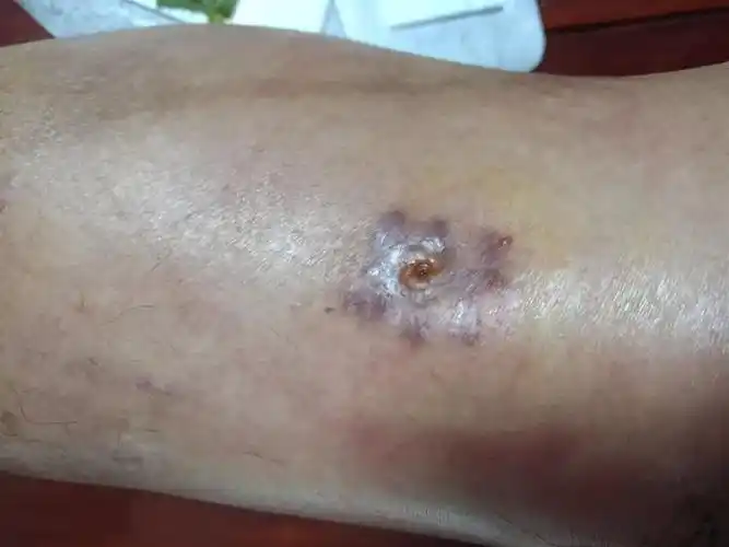 写美篇12月24日 另一钢钉手术伤口也出现感染现象,逐亦用中草药制剂敷