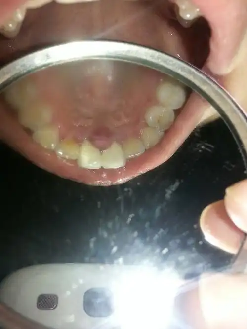 正常人牙龈内侧图片