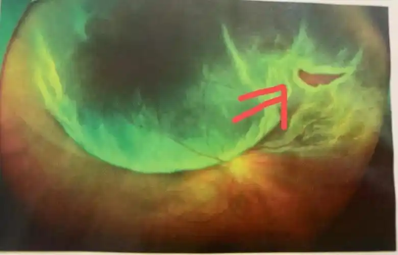 世界对15岁的我如此模糊,因为我眼底有个小洞