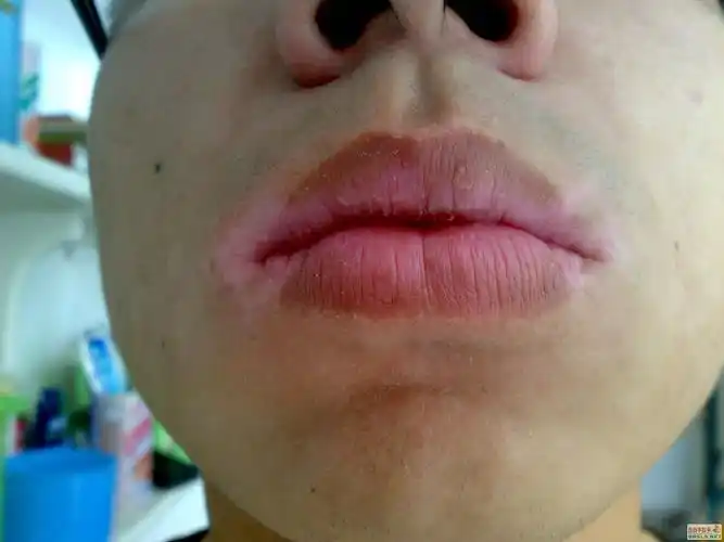 大家帮忙判断下嘴角的白癜风是否在发展期?