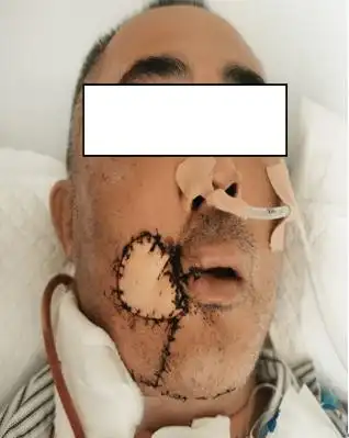 外科完成高难度的口腔癌根治同期自体组织瓣显微外科游离移植手术四例