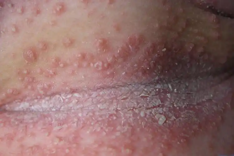 念珠菌感染症状女性用什么 "得能偿失"-第2张图片-红石博客