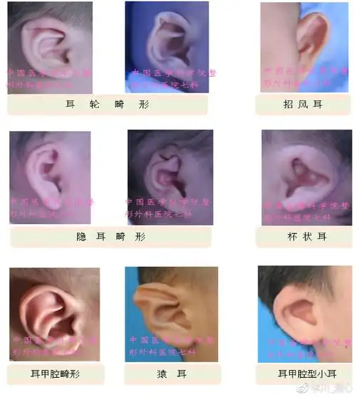 的重度耳廓畸形以及错过非手术治疗时机的患儿,可以先行手术矫正畸形