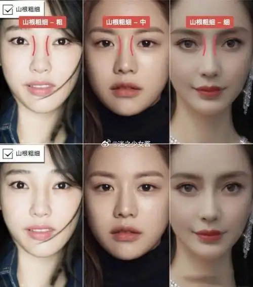 怎么抬高鼻尖的同时避免鼻孔外露?