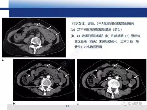 急性肠系膜血管缺血的ct表现及介入治疗