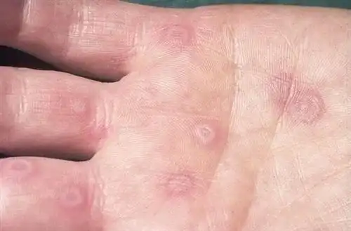 多形红斑早期图片