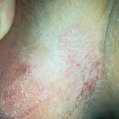 蛋蛋长了一片红红的 帮我看一下这个是什么