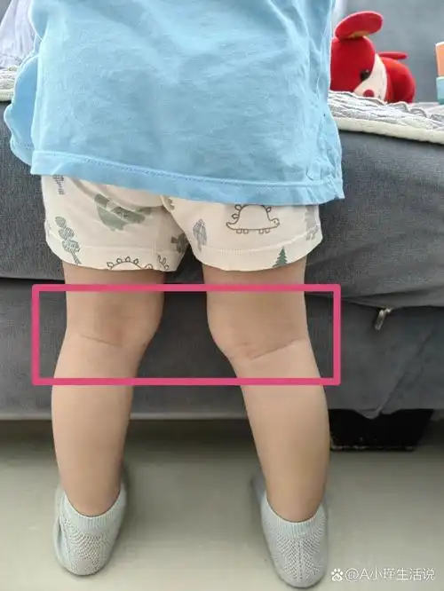 一岁多宝宝的腿型这样正常吗?