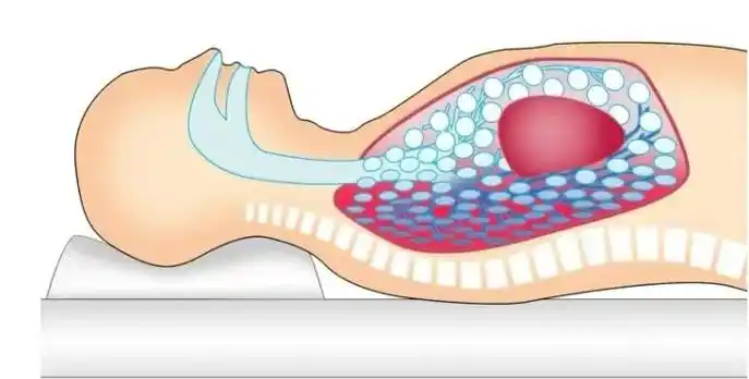 俯卧位通气健康教育单