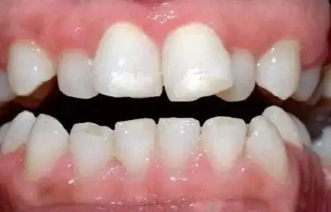 如果不及时清洁,这些黑色沉着物会滋生细菌,导致口臭和蛀牙.