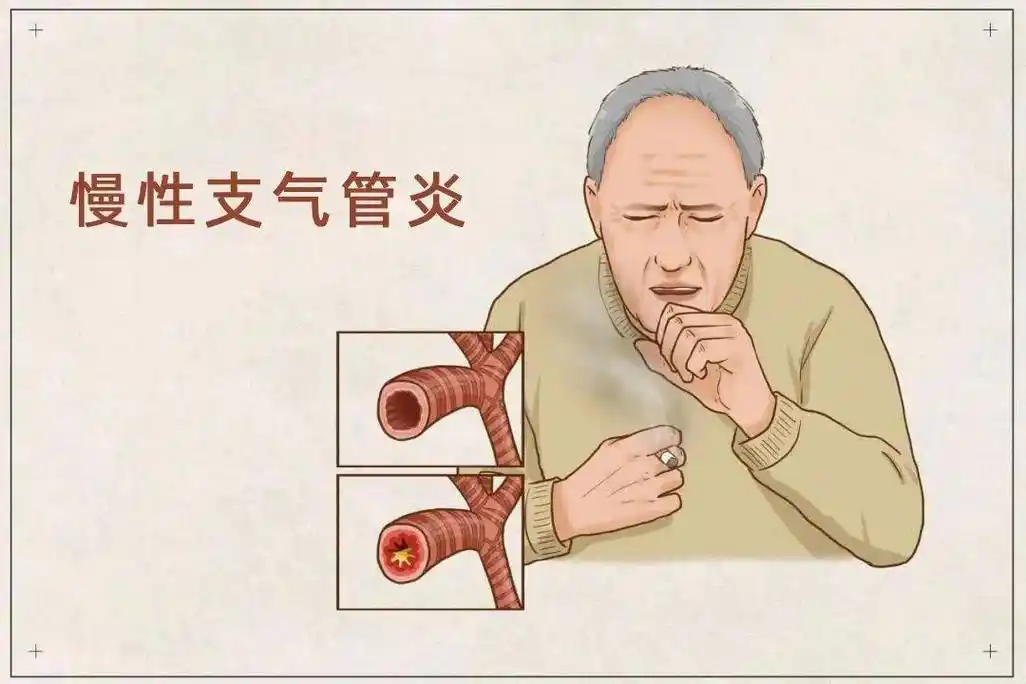 慢性支气管炎反复发作日常护理很重要