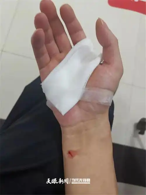 邹鹏在医院包扎 贵州日报天眼新闻记者 施平 通讯员 蔡勇河 编辑 施昱