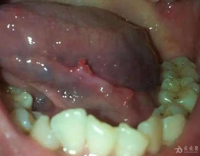 急急急~~不想手术啊》-精准抗艾-互联网艾滋病性病预防诊疗平台