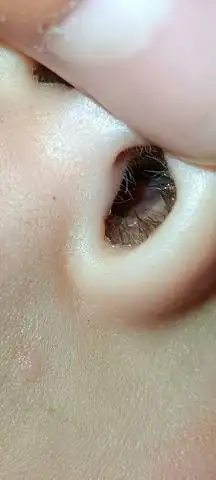 能看出来吗,宝宝才刚刚三岁,鼻腔里长的这是啥呀?