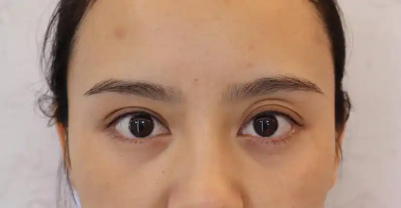 多层褶可以做双眼皮吗 北京西美整形医院刘野院长告诉您