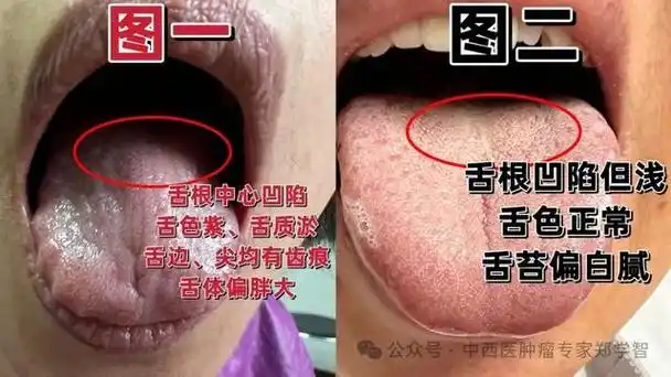 舌象看肿瘤!不同舌象,预后不同!