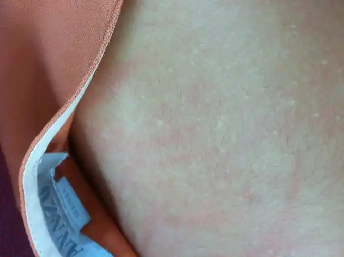 请问专业人士帮忙看看,这个是不是脂肪粒?