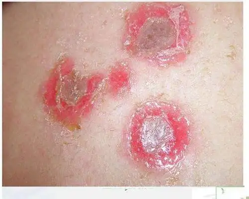 男性一期梅毒图片 (6)_有来医生