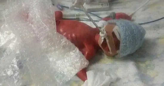 英25周早产双胞胎奇迹存活 日常气泡膜助其保暖