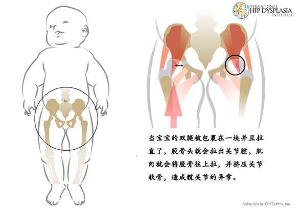 宝宝髋关节这些知识,你都知道吗?
