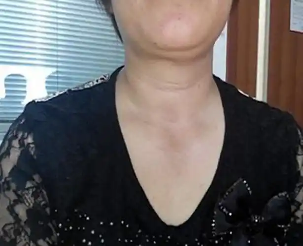 甲状腺炎图片_甲状腺炎症状表现图片大全_有来医生