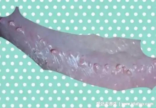 1,假性湿疣珍珠疹图片2,尖锐湿疣图片珍珠疹症状1,女性主要分布在小