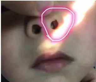 3岁女童浑身散发恶臭,医生竟从鼻腔取出个大家伙,家人当场作呕