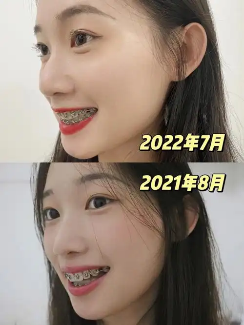 正畸680天目前牙齿矫正效果我太满意啦