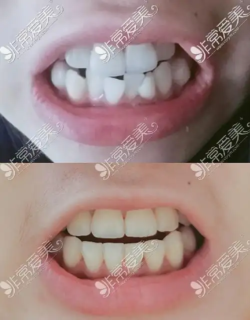 20岁整牙已经来不及了戴了牙套矫正不过来都是浪费