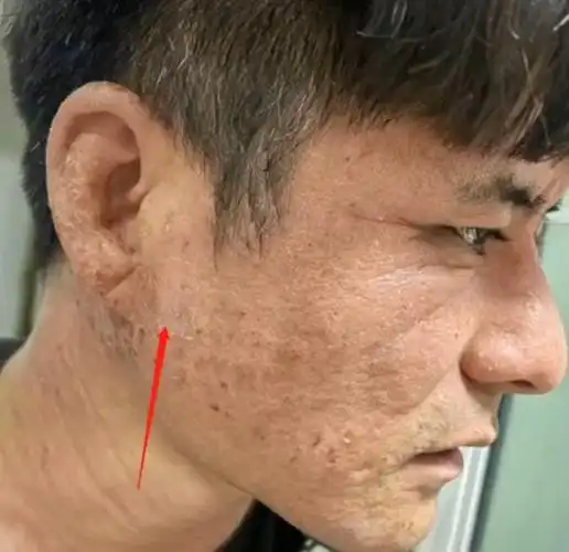 患上湿疹后的刘晓东面部皮肤坑坑洼洼,就像是癞蛤蟆的皮一样粗糙,而