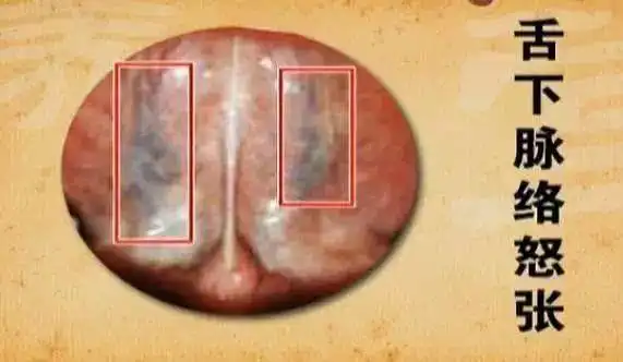 得癌症的人舌头已经这样了