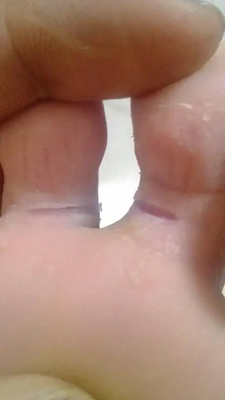 脚趾缝裂开了一条口子,好疼.