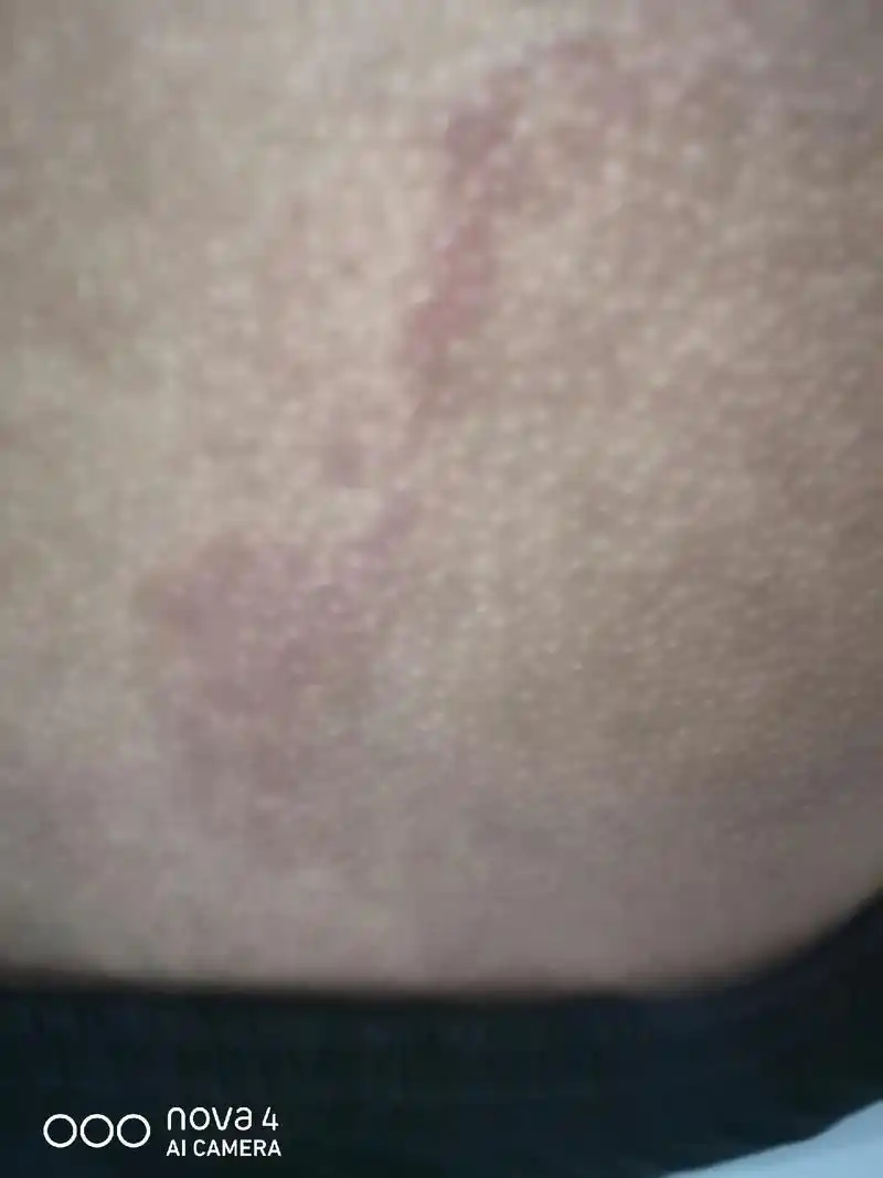 这个皮肤病太顽固了,在医院检查是螨虫过敏.