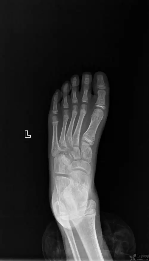 病史:男,7岁,左足跖骨疼痛10余天