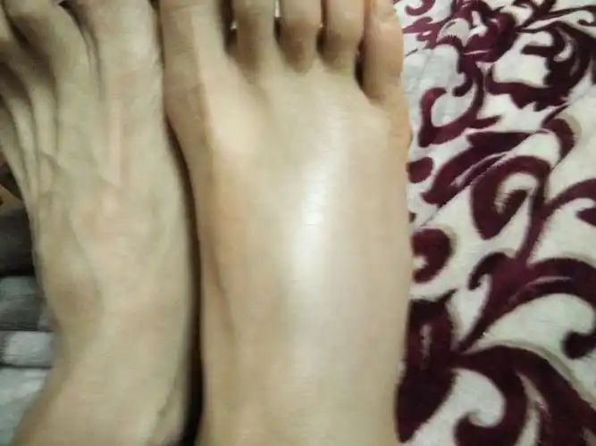 崴脚了――第一次脚肿这么厉害!