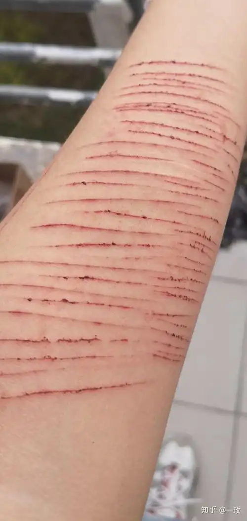 高中时候,高一时候开始疯狂地自残,一直到现在这个习惯也没有改.