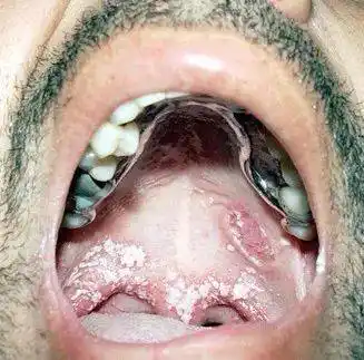 民间治疗"口疮"的小妙招1,冰糖:长"口疮"时,在口里含几块冰糖,对"口疮