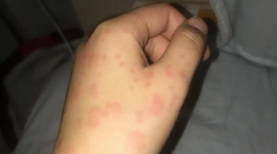 荨麻疹症状图片荨麻疹是由什么引起的