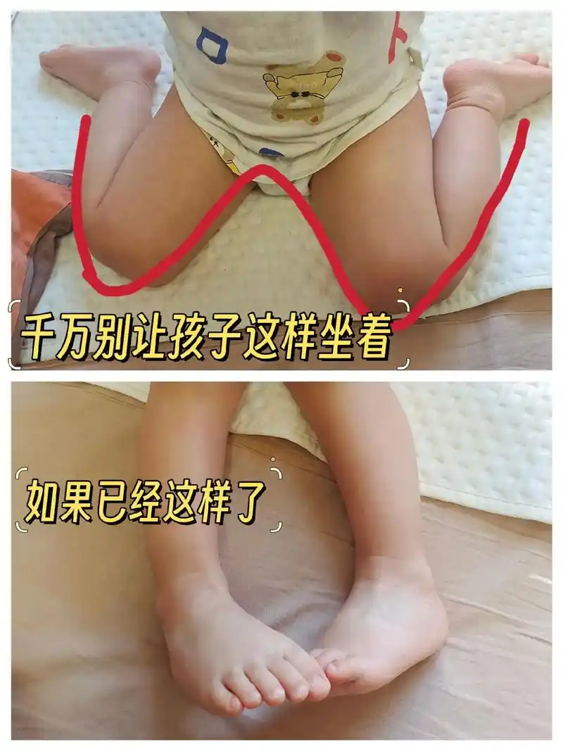 w坐姿的危害到底有多大 w坐姿又称电视儿童坐姿