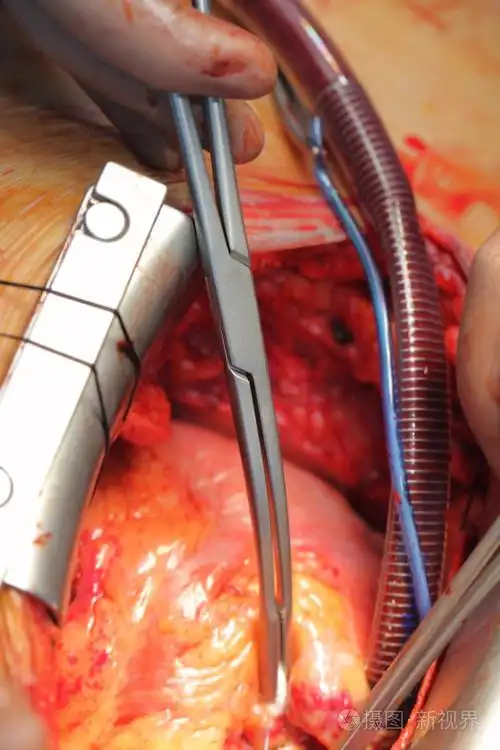 对心脏和血管的手术.特写照片照片-正版商用图片1gnypm-摄图新视界